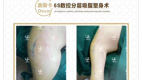 苏州腰腹抽脂减肥指南安全塑形全解析